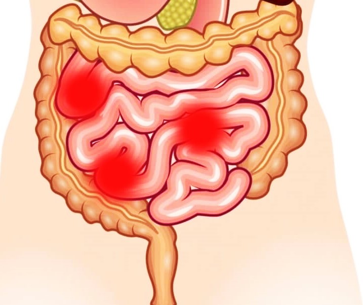 Diet to combat dyspepsia