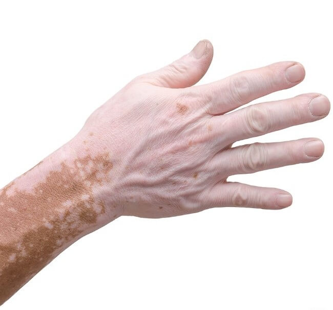 vitiligo skin